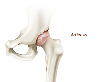 Arthritic Hip Joint